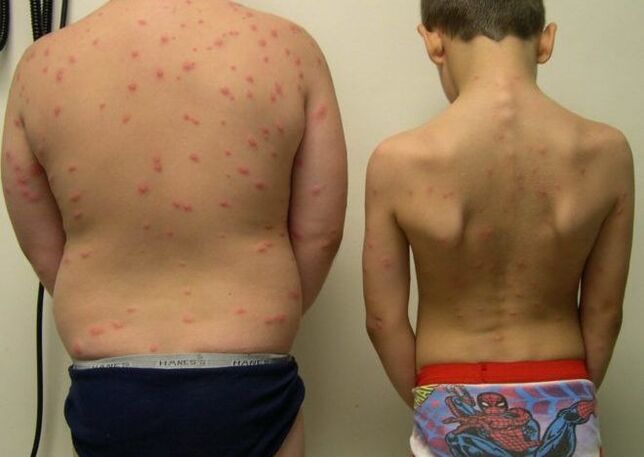Skin rashes on the skin with worms