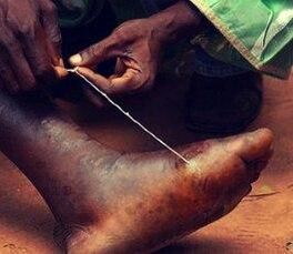 Parasite at a person's foot