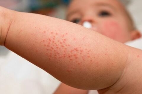Allergy in children as a symptom of the presence of worms