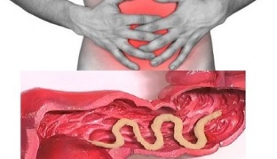 symptoms of the presence of parasites in the human intestine